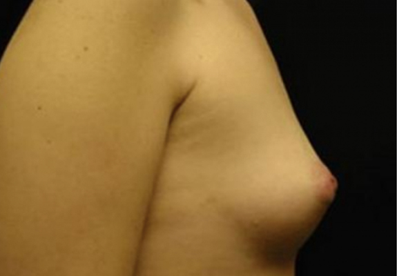 dr nitta gallery breast augmentation 1 side before