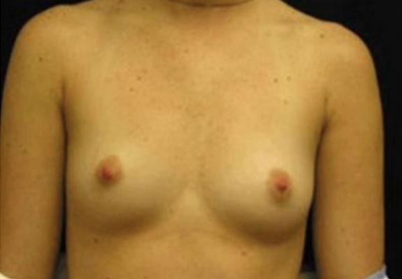 dr nitta gallery breast augmentation 2 front before