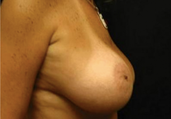 dr nitta gallery breast augmentation 3 side after
