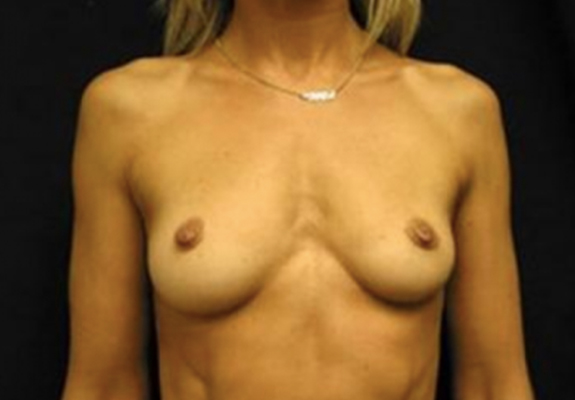 dr nitta gallery breast augmentation 4 front before
