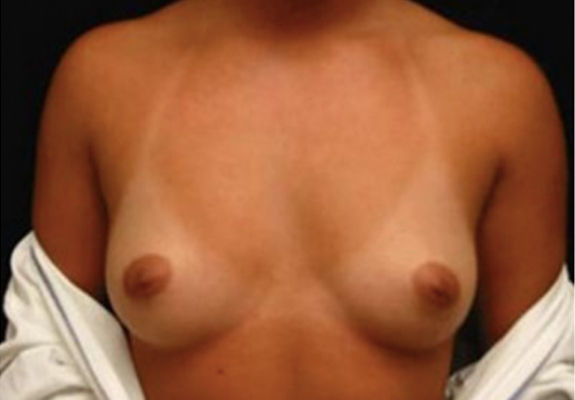 dr nitta gallery breast augmentation 5 front before