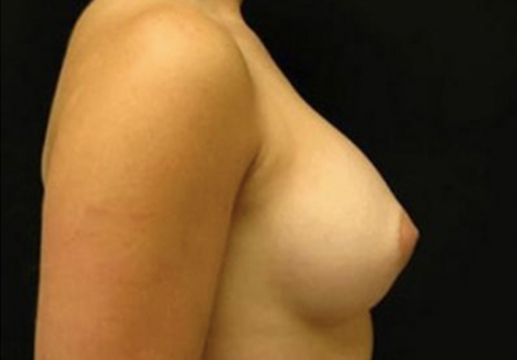 dr nitta gallery breast augmentation 5 side after new