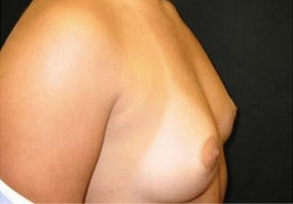 dr nitta gallery breast augmentation 5 side before