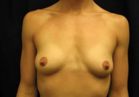 dr nitta gallery breast augmentation 6 front before