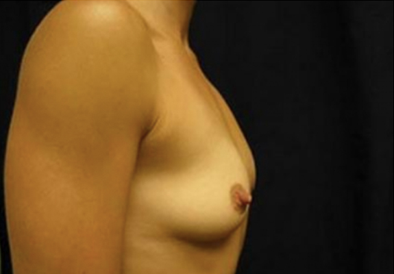 dr nitta gallery breast augmentation 6 side before
