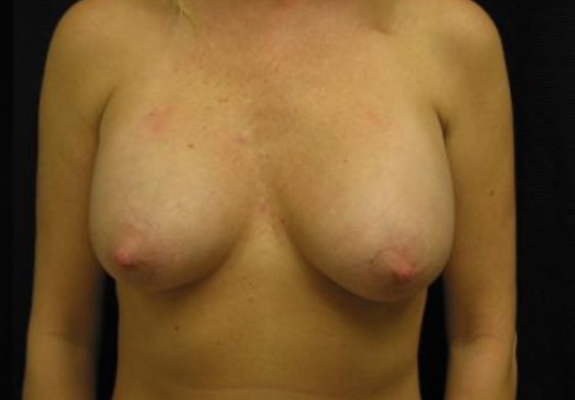 dr nitta gallery breast augmentation 7 front after