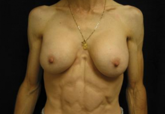 dr nitta gallery breast augmentation 8 front after