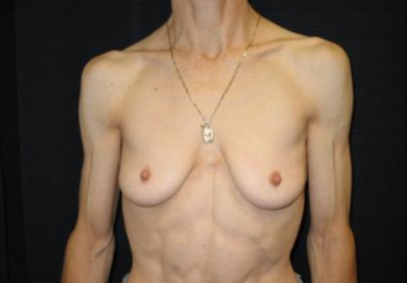 dr nitta gallery breast augmentation 8 front before