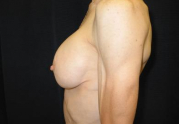 dr nitta gallery breast augmentation 8 side after