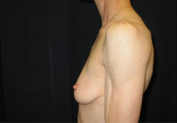 dr nitta gallery breast augmentation 8 side before