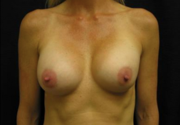 dr nitta gallery breast augmentation 9 front after