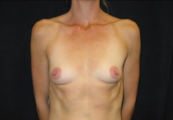dr nitta gallery breast augmentation 9 front before