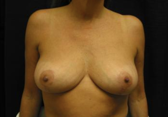dr nitta gallery breast lift 1 front after