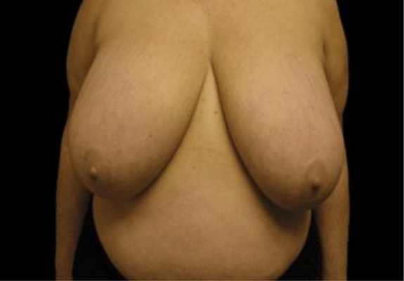 dr nitta gallery breast reduction 3 front before