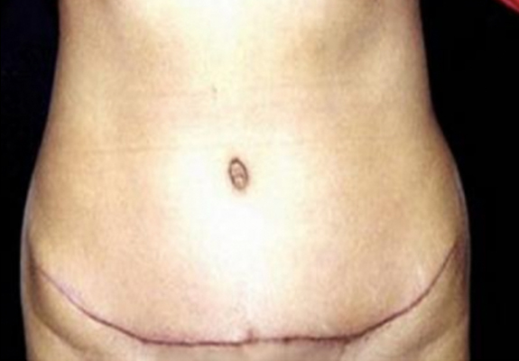 dr nitta gallery tummy tuck 1 after