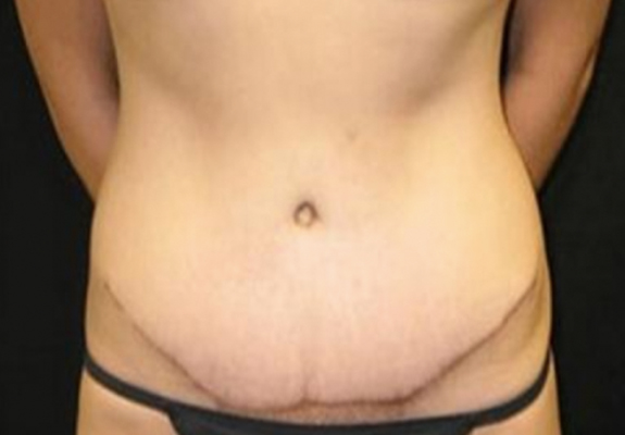 dr nitta gallery tummy tuck 3 after