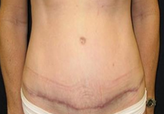 dr nitta gallery tummy tuck 5 after