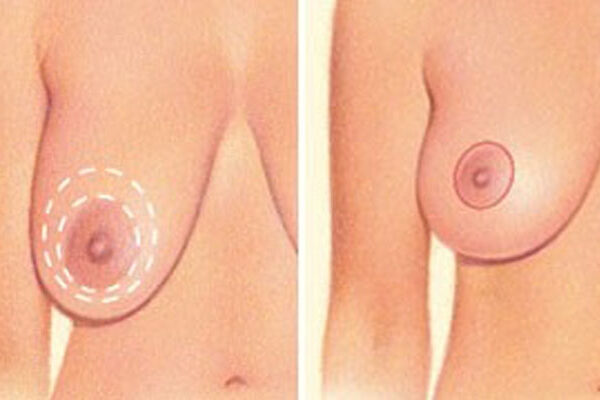 dr nitta breast lift types 1