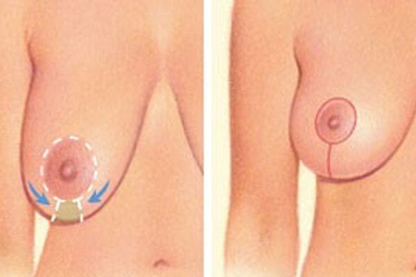 dr nitta breast lift types 2